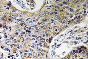 Immunohistochemistry (IHC) analyzes of ATP5J2 antibody in paraffin-embedded human lung carcinoma tissue.