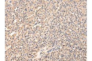 The image on the left is immunohistochemistry of paraffin-embedded Human breast cancer tissue using ABIN7128083(VIP Antibody) at dilution 1/20, on the right is treated with fusion protein. (Vip anticorps)