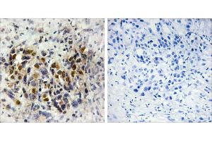 Peptide - +Immunohistochemistry analysis of paraffin-embedded human breast carcinoma tissue, using IRX3 antibody.