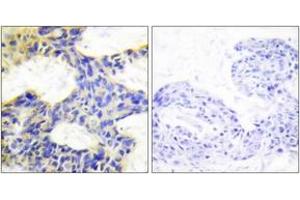 Immunohistochemistry analysis of paraffin-embedded human breast carcinoma tissue, using S6K Antibody. (RPS6KB1 anticorps  (AA 261-310))