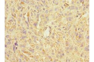 Immunohistochemistry of paraffin-embedded human melanoma using ABIN7143004 at dilution of 1:100