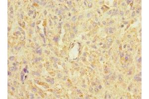 Immunohistochemistry of paraffin-embedded human melanoma using ABIN7143004 at dilution of 1:100 (ASIC3 anticorps  (AA 62-320))