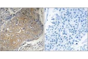 Immunohistochemistry analysis of paraffin-embedded human lung carcinoma tissue, using MRPS33 Antibody.