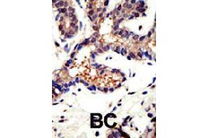 Formalin-fixed and paraffin-embedded human cancer tissue reacted with UBQLN3 polyclonal antibody  , which was peroxidase-conjugated to the secondary antibody, followed by DAB staining . (Ubiquilin 3 anticorps  (N-Term))