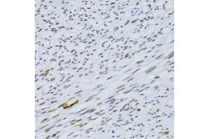 Immunohistochemistry of paraffin-embedded human uterine cancer using SNRNP70 antibody.