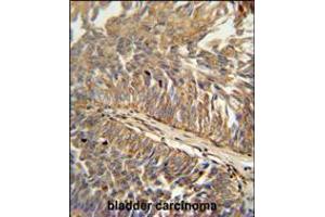 ATP13A3 antibody immunohistochemistry analysis in formalin fixed and paraffin embedded human bladder carcinoma followed by peroxidase conjugation of the secondary antibody and DAB staining.