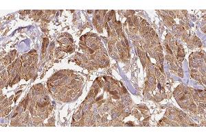 ABIN6275896 at 1/100 staining Human Melanoma tissue by IHC-P. (FAM3D anticorps  (C-Term))