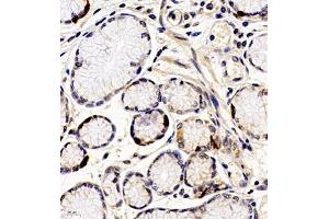 Immunohistochemistry of paraffin embedded human gastric cancer using ANKK1 (ABIN7073056) at dilution of 1:200 (400x lens) (ANKK1 anticorps)