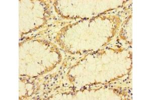 Immunohistochemistry of paraffin-embedded human colon cancer using ABIN7173655 at dilution of 1:100 (TUBA1B anticorps  (AA 29-310))