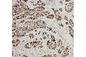 Anti-MCM2 antibody, IHC(P) IHC(P): Human Lung Cancer Tissue (MCM2 anticorps  (C-Term))