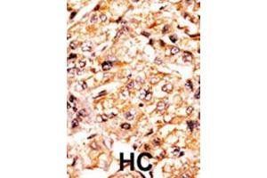 Formalin-fixed and paraffin-embedded human cancer tissue reacted with the primary antibody, which was peroxidase-conjugated to the secondary antibody, followed by AEC staining.