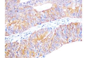 Immunohistochemistry of paraffin-embedded human colon carcinoma using Cyclophilin 40 Rabbit mAb (ABIN7269213) at dilution of 1:100 (40x lens).