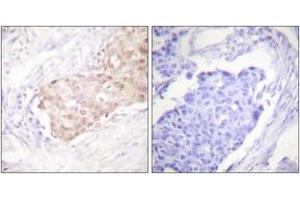 Immunohistochemistry analysis of paraffin-embedded human breast carcinoma tissue, using EDD Antibody. (UBR5 anticorps  (AA 1-50))