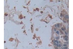 Detection of ALPL in Human Breast cancer Tissue using Polyclonal Antibody to Alkaline Phosphatase, Tissue-nonspecific (ALPL)