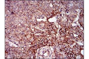 Immunohistochemical analysis of paraffin-embedded prostate cancer tissues using mSplunc2 mouse mAb with DAB staining. (BPIFA2 anticorps  (AA 16-169))
