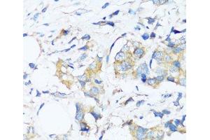 Immunohistochemistry of paraffin-embedded Human breast cancer using BAG3 Polyclonal Antibody at dilution of 1:100 (40x lens).