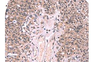 The image on the left is immunohistochemistry of paraffin-embedded Human ovarian cancer tissue using ABIN7190608(EXTL1 Antibody) at dilution 1/20, on the right is treated with synthetic peptide. (EXTL1 anticorps)
