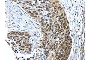 The image on the left is immunohistochemistry of paraffin-embedded Human esophagus cancer tissue using (TKTL1 Antibody) at dilution 1/40, on the right is treated with fusion protein. (TKTL1 anticorps)
