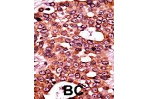 Formalin-fixed and paraffin-embedded human cancer tissue reacted with CDC6 (phospho S54) polyclonal antibody  which was peroxidase-conjugated to the secondary antibody followed by AEC staining. (CDC6 anticorps  (pSer54))