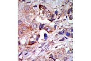 Formalin-fixed and paraffin-embedded human cancer tissue (breast carcinoma) reacted with the primary antibody, which was peroxidase-conjugated to the secondary antibody, followed by AEC staining.