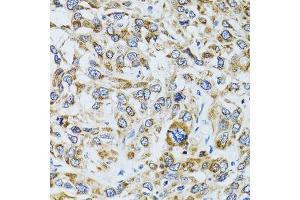 Immunohistochemistry of paraffin-embedded human liver cancer using RPN1 antibody. (RPN1 anticorps  (AA 20-280))