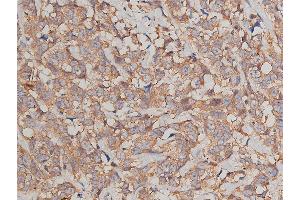 ABIN6269036 at 1/200 staining human breast cancer tissue sections by IHC-P. (JUP anticorps  (C-Term))