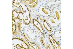 Immunohistochemistry of paraffin-embedded human kidney cancer using GLRX Antibody (ABIN1876503) at dilution of 1:200 (40x lens). (Glutaredoxin 1 anticorps)