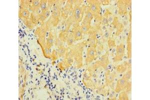 Immunohistochemistry of paraffin-embedded human liver cancer using ABIN7158796 at dilution of 1:100