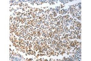 Immunohistochemical analysis of paraffin-embedded Human liver cancer tissue using at dilution 1/40.