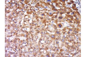 Formalin-fixed and paraffin embedded human liver carcinoma labeled with Anti-FAIM3 Polyclonal Antibody, Unconjugated  at 1:500 followed by conjugation to the secondary antibody and DAB staining. (FAIM3 anticorps  (AA 51-150))