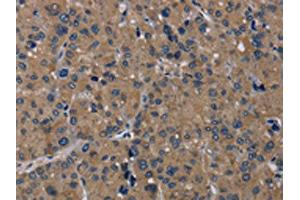 The image on the left is immunohistochemistry of paraffin-embedded Human liver cancer tissue using ABIN7192919(TRPM1 Antibody) at dilution 1/20, on the right is treated with synthetic peptide. (TRPM1 anticorps)