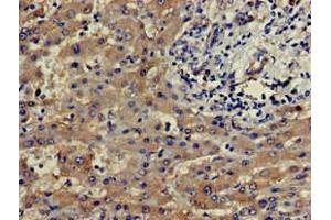 Immunohistochemistry of paraffin-embedded human liver cancer using ABIN7164181 at dilution of 1:100 (SLU7 anticorps  (AA 138-310))