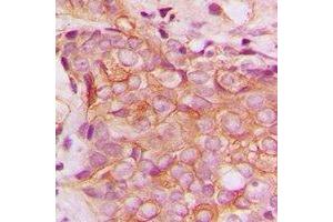 Immunohistochemical analysis of HER2 staining in human breast cancer formalin fixed paraffin embedded tissue section.
