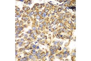 Immunohistochemistry of paraffin-embedded human esophageal cancer using TOMM20 antibody.