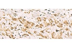 Immunohistochemistry of paraffin-embedded Human gastric cancer tissue using PDS5A Polyclonal Antibody at dilution of 1:90(x200)