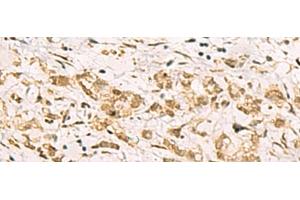 Immunohistochemistry of paraffin-embedded Human gastric cancer tissue using PDS5A Polyclonal Antibody at dilution of 1:90(x200) (PDS5A anticorps)