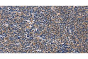 Immunohistochemistry of paraffin-embedded Human Lymphoma tissue using CD5L Polyclonal Antibody at dilution 1:40 (CD5L anticorps)