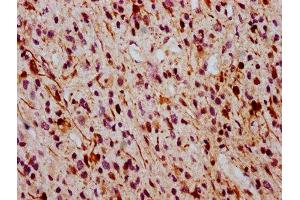 IHC image of ABIN7127707 diluted at 1:100 and staining in paraffin-embedded human glioma cancer performed on a Leica BondTM system. (Recombinant ERK1 anticorps  (pThr185, pThr202))