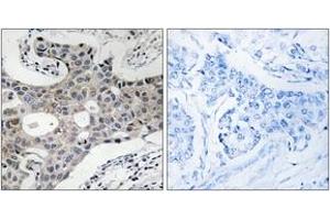 Immunohistochemistry analysis of paraffin-embedded human breast carcinoma, using SEC16A Antibody.