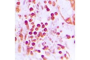 Immunohistochemical analysis of CstF-50 staining in human prostate cancer formalin fixed paraffin embedded tissue section.
