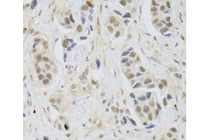 Immunohistochemistry of paraffin-embedded Human breast cancer using UBE3C Polyclonal Antibody at dilution of 1:100 (40x lens).