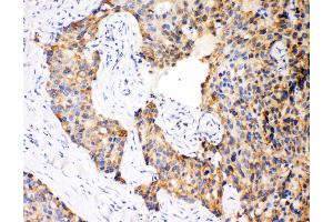 Anti-Caspase-12 antibody, IHC(P) IHC(P): Human Mammary Cancer Tissue