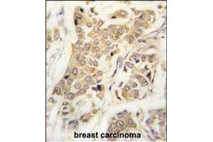 Formalin-fixed and paraffin-embedded human breast carcinoma tissue reacted with CDH8 antibody (N-term) (ABIN388149 and ABIN2846895) , which was peroxidase-conjugated to the secondary antibody, followed by DAB staining. (Cadherin 8 anticorps  (N-Term))