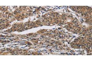 Immunohistochemistry of paraffin-embedded Human gastric cancer using IFNGR2 Polyclonal Antibody at dilution of 1:40 (IFNGR2 anticorps)