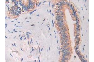 DAB staining on IHC-P; Samples: Human Bile duct cancer Tissue (Cathelicidin anticorps)