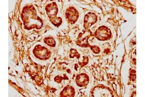 IHC image of ABIN7157677 diluted at 1:300 and staining in paraffin-embedded human breast cancer performed on a Leica BondTM system.