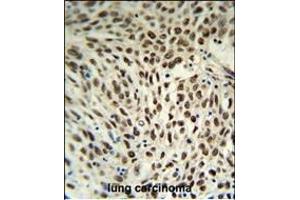 SNRPD3 Antibody (C-term) (ABIN653228 and ABIN2842762) IHC analysis in formalin fixed and paraffin embedded human lung carcinoma followed by peroxidase conjugation of the secondary antibody and DAB staining. (SNRPD3 anticorps  (C-Term))