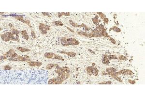 Immunohistochemistry of paraffin-embedded Human liver cancer tissue using CK-19 Polyclonal Antibody at dilution of 1:200.
