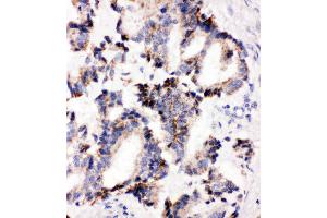 Anti-IRAK2 antibody, IHC(P) IHC(P): Human Lung Cancer Tissue (IRAK2 anticorps  (C-Term))