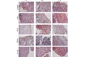 IHC of the expression patterns of (myo)fibroblast, TGFβ1, CTGF, and collagen in human adenomyotic endometrium specimens.
